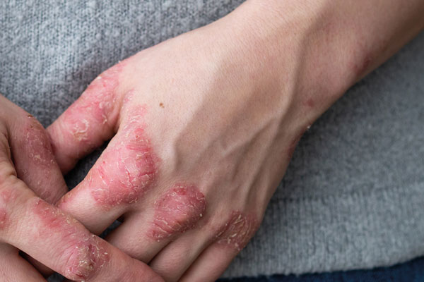 Conoce la Psoriasis